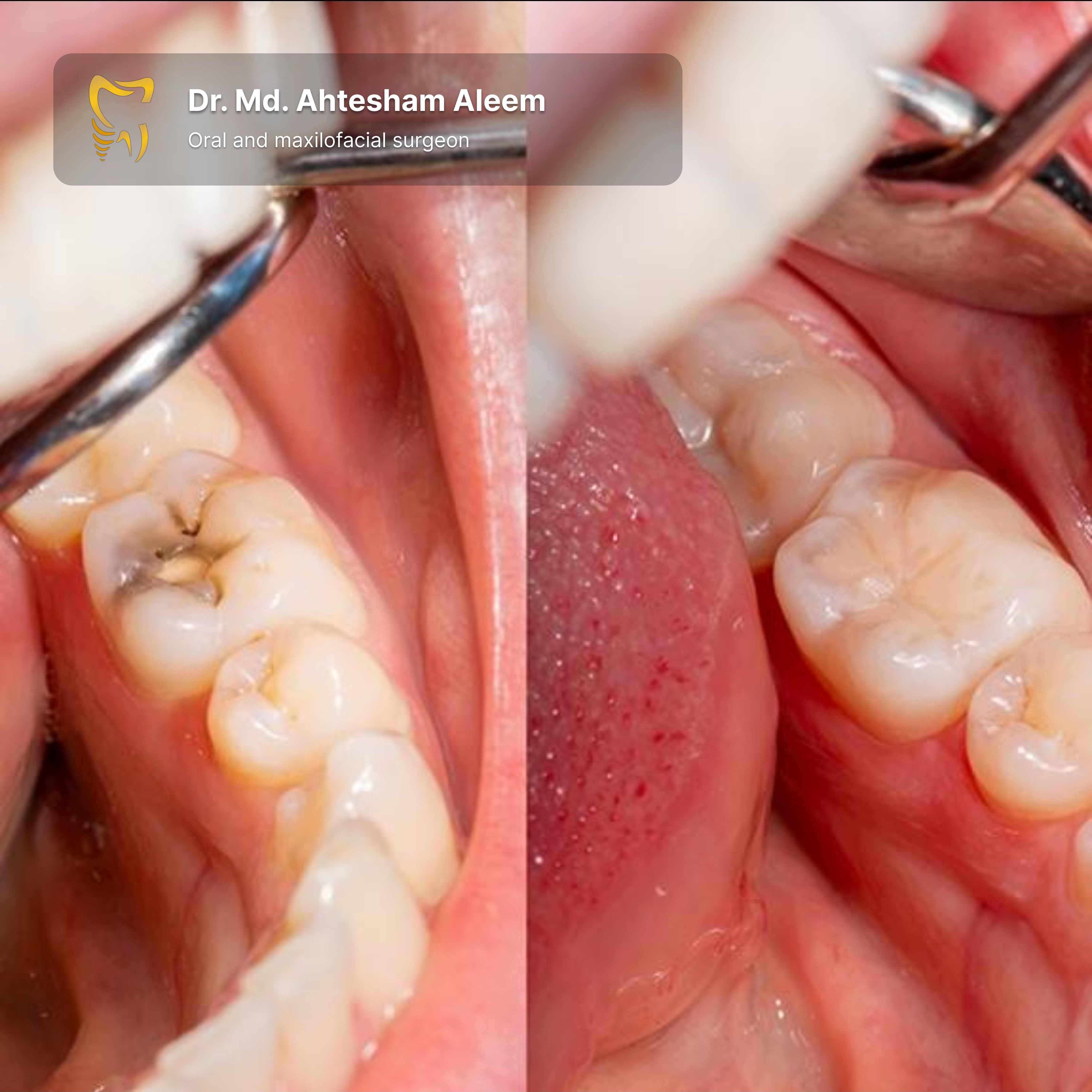 Tooth-Coloured Fillings Gallery 1